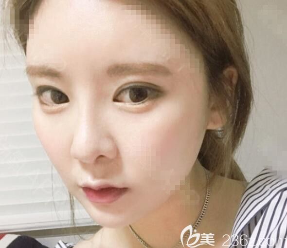 佳轮韩金男昊下颌角颧骨安泰柱双眼皮鼻子脂肪填充5个月后感觉自己好夸张