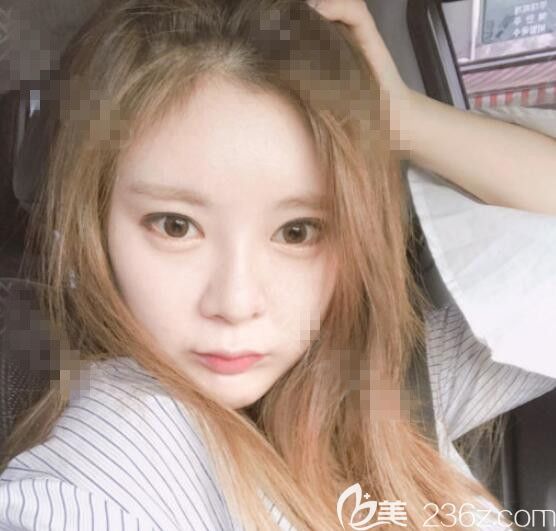 佳轮韩安泰柱院长双眼皮隆鼻真人案例 佳轮韩安泰柱院长双眼皮隆鼻真人案例