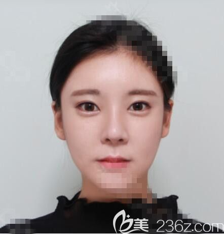 韩国佳轮韩整形医院：下颌角+下巴+颧骨真人案例
