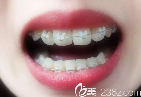 我35岁才去重庆美维口腔做陶瓷托槽牙齿矫正,是因受够了牙齿拥挤的折磨