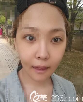 NJH卢钟勋整形轮廓什么风格