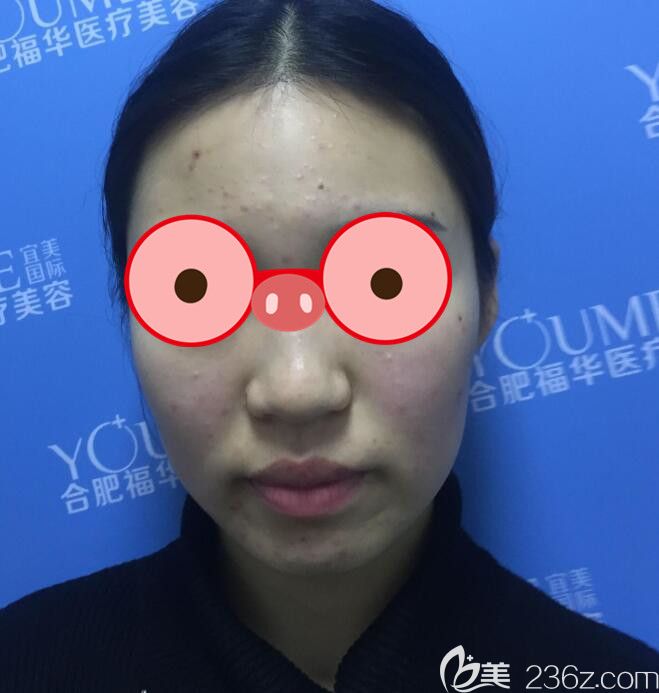 不清楚合肥福华整形怎么样，可以看院长给我做的面部吸脂21天恢复过程图