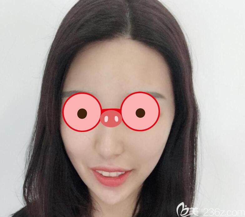 <!--<i data=20240703-sp></i>-->做面部吸脂第7天恢复情况