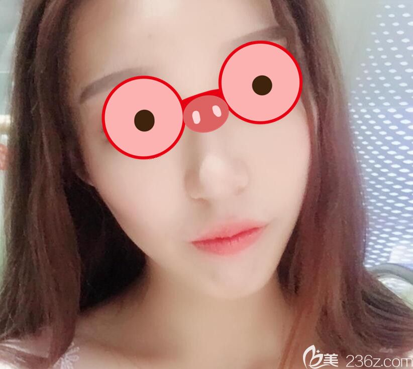 面部抽脂瘦脸半个月