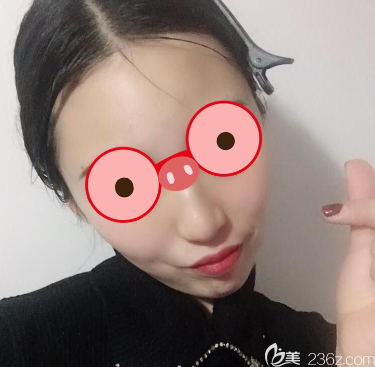 合肥福华整形面部吸脂21效果图