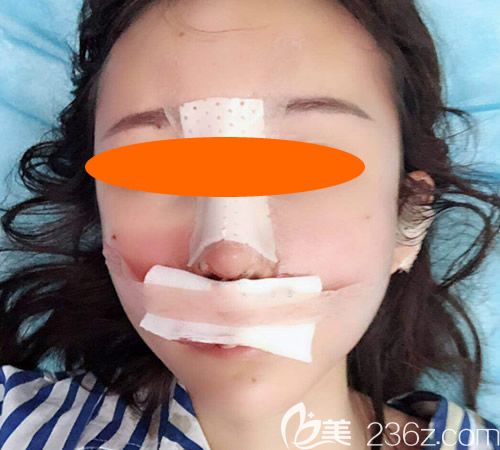去南昌广济医院找唐辉做了硅胶+肋软骨隆鼻手术当天照片