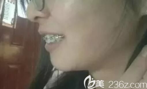 <!--<i data=20240703-sp></i>-->臻威口腔龅牙戴钢丝牙套矫正250天 <!--<i data=20240703-sp></i>-->臻威口腔龅牙戴钢丝牙套矫正250天