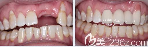 天津中诺口腔马丽娟医生多颗牙缺失种植案例对比图
