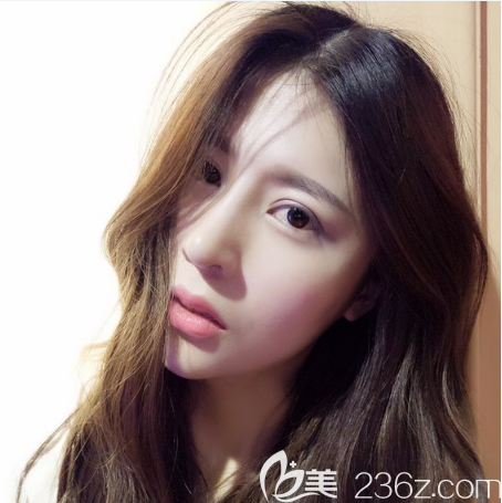 双眼皮隆鼻术后一个月恢复照片