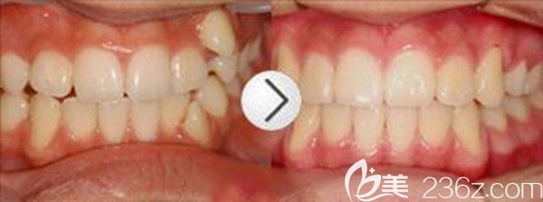 牙齿矫正前后效果图 牙齿矫正前后效果图