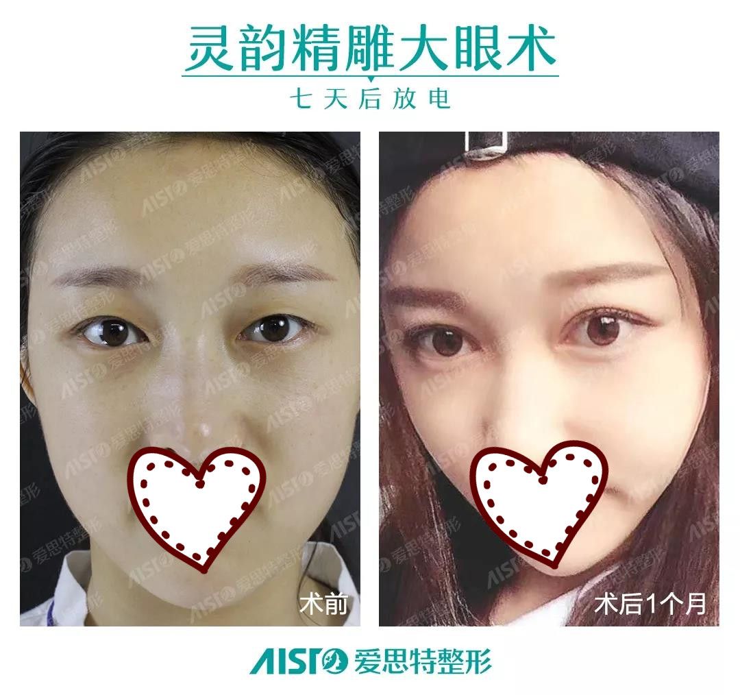 南宁爱思特整形精雕双眼皮案例