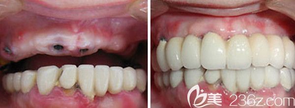 ALL-on-4半口种植前后对比图 ALL-on-4半口种植前后对比图