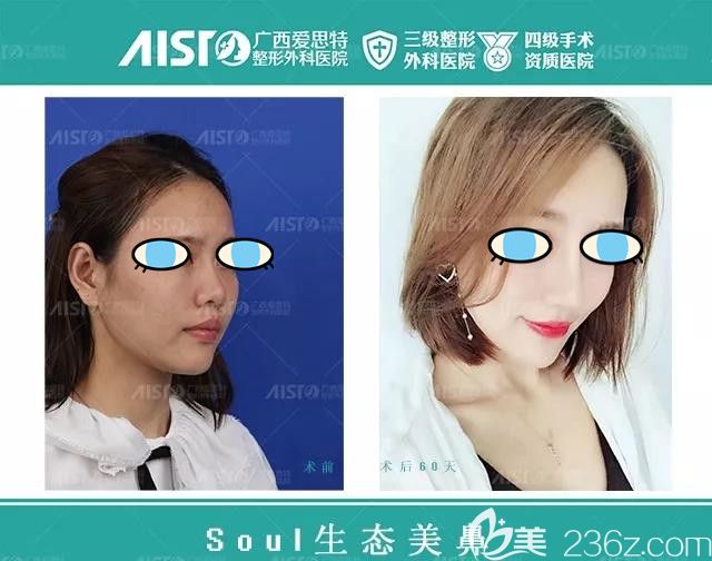 南宁爱思特整形鼻综合隆鼻案例