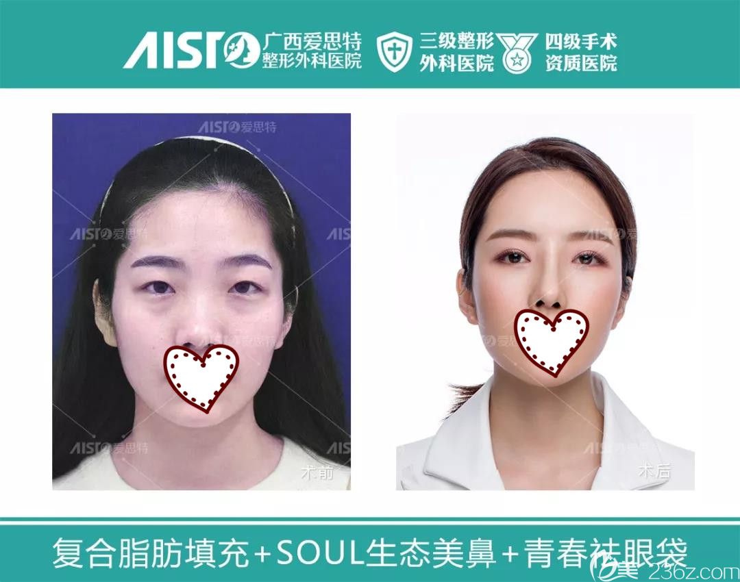 南宁爱思特整形全脸自体脂肪填充案例