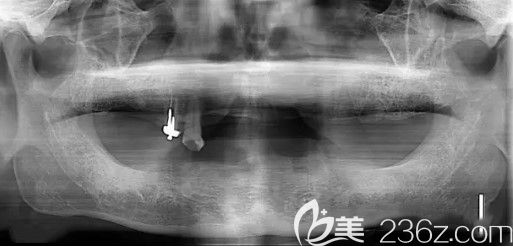 我全口牙缺失在天津中诺口腔做种植牙前CT片 我全口牙缺失在天津中诺口腔做种植牙前CT片
