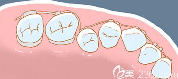 牙齿不整齐需做口腔正畸 牙齿不整齐需做口腔正畸