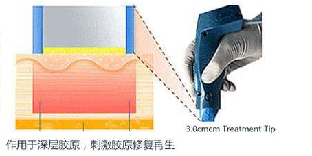 热玛吉除皱原理 热玛吉除皱原理