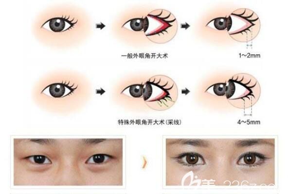 韩国女生开的外眼角是哪一种韩国gio眼部修复整形医院讲开外眼角会后
