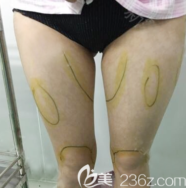 去<!--<i data=20240703-sp></i>-->做大腿吸脂前的图片 去<!--<i data=20240703-sp></i>-->做大腿吸脂前的图片