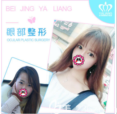 北京雅靓陈林叶医生切开双眼皮案例
