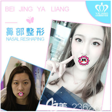 北京雅靓陈林叶医生肋软骨隆鼻案例
