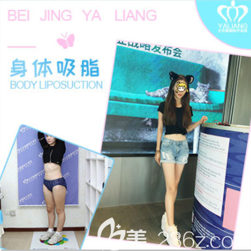 北京雅靓陈林叶医生腰腹吸脂案例