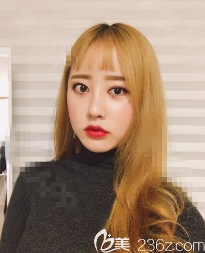 首尔丽丝塔金东奭鼻综合双眼皮修复线提升脂肪填充术后由路人甲变女神你们觉得呢