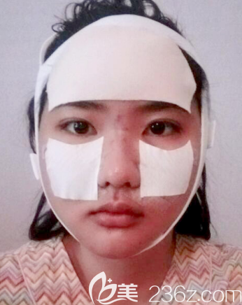 韩国拉菲安自体脂肪面部填充+颧骨颧弓整形+拉皮手术案例术后第2天效果图