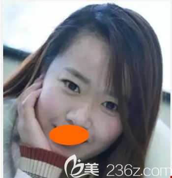 没去西宁时光整形美容医院割双眼皮+假体隆鼻前照片 没去西宁时光整形美容医院割双眼皮+假体隆鼻前照片