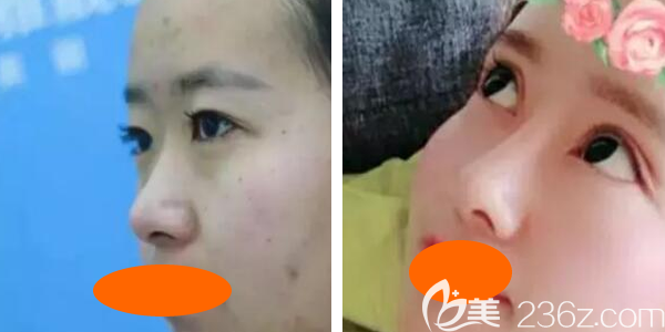 我到西宁时光整形割双眼皮+假体隆鼻综合手术后3个月<span style= 我到西宁时光整形割双眼皮+假体隆鼻综合手术后3个月<span style=