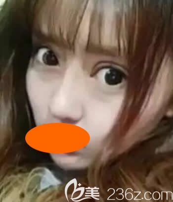 我到西宁时光整形割双眼皮+假体隆鼻综合手术后1个月<span style= 我到西宁时光整形割双眼皮+假体隆鼻综合手术后1个月<span style=