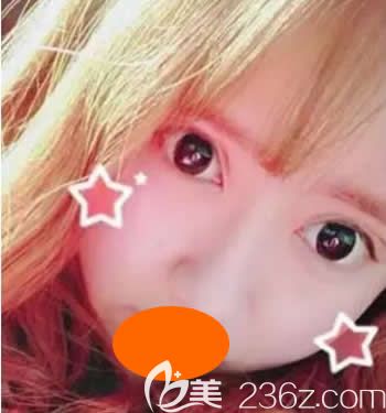 我到西宁时光整形割双眼皮+假体隆鼻综合手术后第18天<span style= 我到西宁时光整形割双眼皮+假体隆鼻综合手术后第18天<span style=