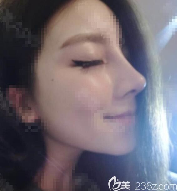 肋骨隆鼻术后8天