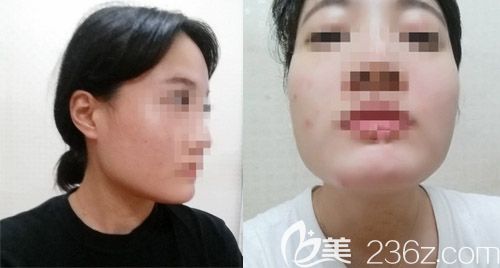 韩国爱我整形医院朴范镇3D颧骨颧弓+下颌角整形案例 韩国爱我整形医院朴范镇3D颧骨颧弓+下颌角整形案例