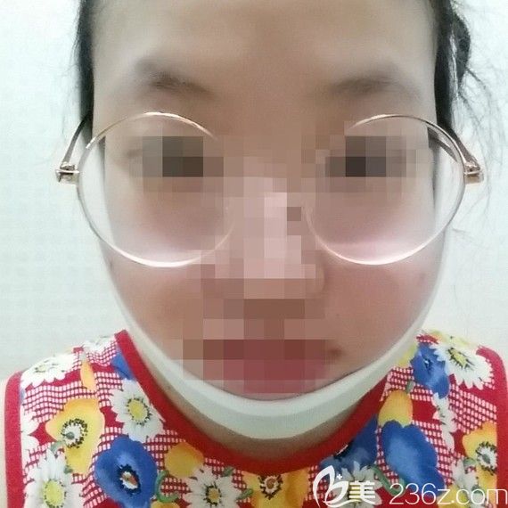 韩国爱我整形医院朴范镇颧骨颧弓+下颌角案例术后恢复过程图