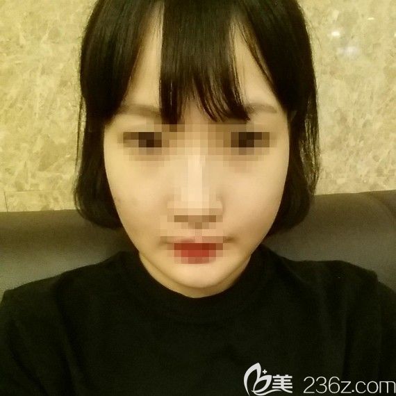 韩国爱我整形朴范镇面部轮廓整形案例 韩国爱我整形朴范镇面部轮廓整形案例