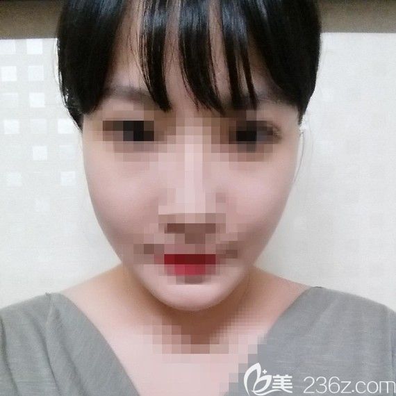 韩国爱我整形医院面部轮廓怎么样?朴范镇案例 韩国爱我整形医院面部轮廓怎么样?朴范镇案例