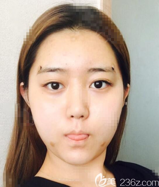 韩国维摩做面部脂肪填充怎么样 韩国维摩做面部脂肪填充怎么样