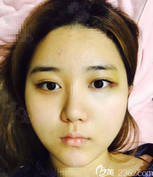 韩国维摩脂肪填充真人案例 韩国维摩脂肪填充真人案例