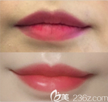 丰唇前后对比效果图 丰唇前后对比效果图