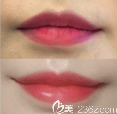 韩国非手术微笑唇前后对比照 韩国非手术微笑唇前后对比照