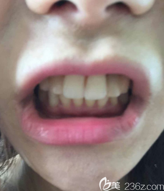 瓷贴面术前 瓷贴面术前