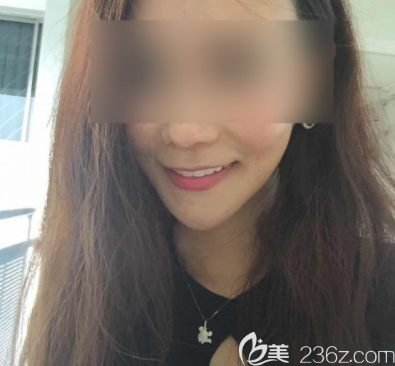 瓷贴面术后 瓷贴面术后