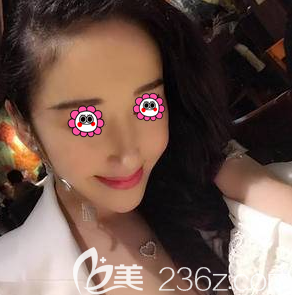 在北京画美做鼻修复前样子 在北京画美做鼻修复前样子