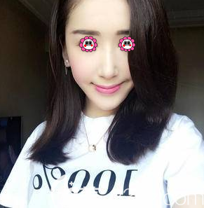 北京画美做鼻修复第67天样子 北京画美做鼻修复第67天样子