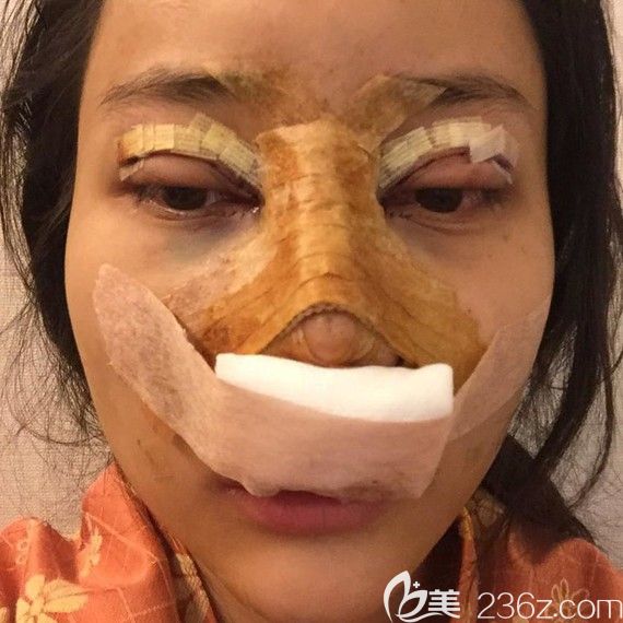 韩国自然主义双眼皮+开眼角+假体隆鼻术后效果