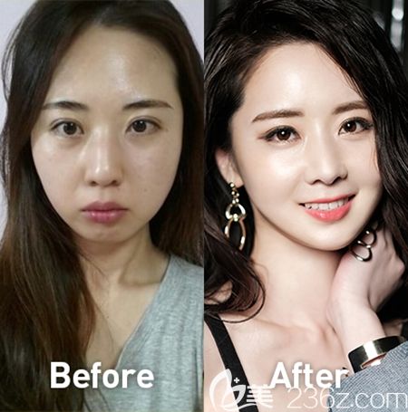 韩国必妩整形医院面部轮廓案例 韩国必妩整形医院面部轮廓案例