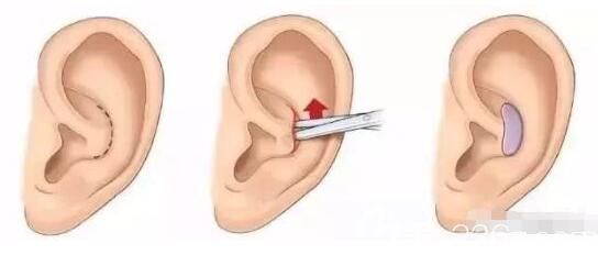 耳软骨隆鼻取骨位置