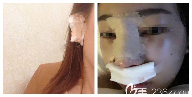 刚做完自体耳软骨鼻综合术后即刻效果