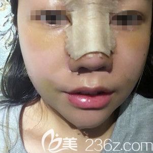 术后三天鼻综合恢复效果